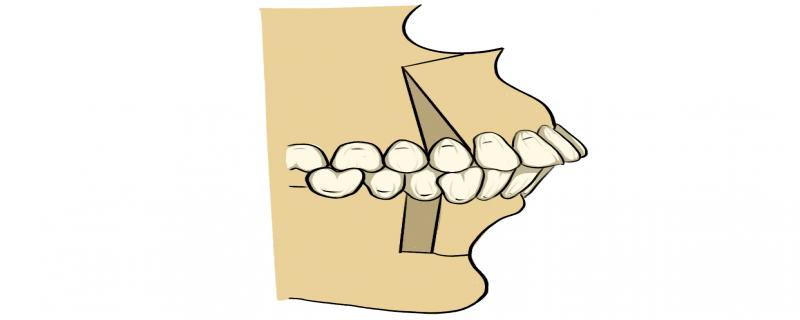 牙齒上牙槽骨突出怎么辦