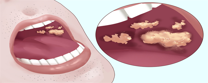 为什么会长口腔溃疡