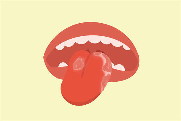 舌癌的早期症状有哪些