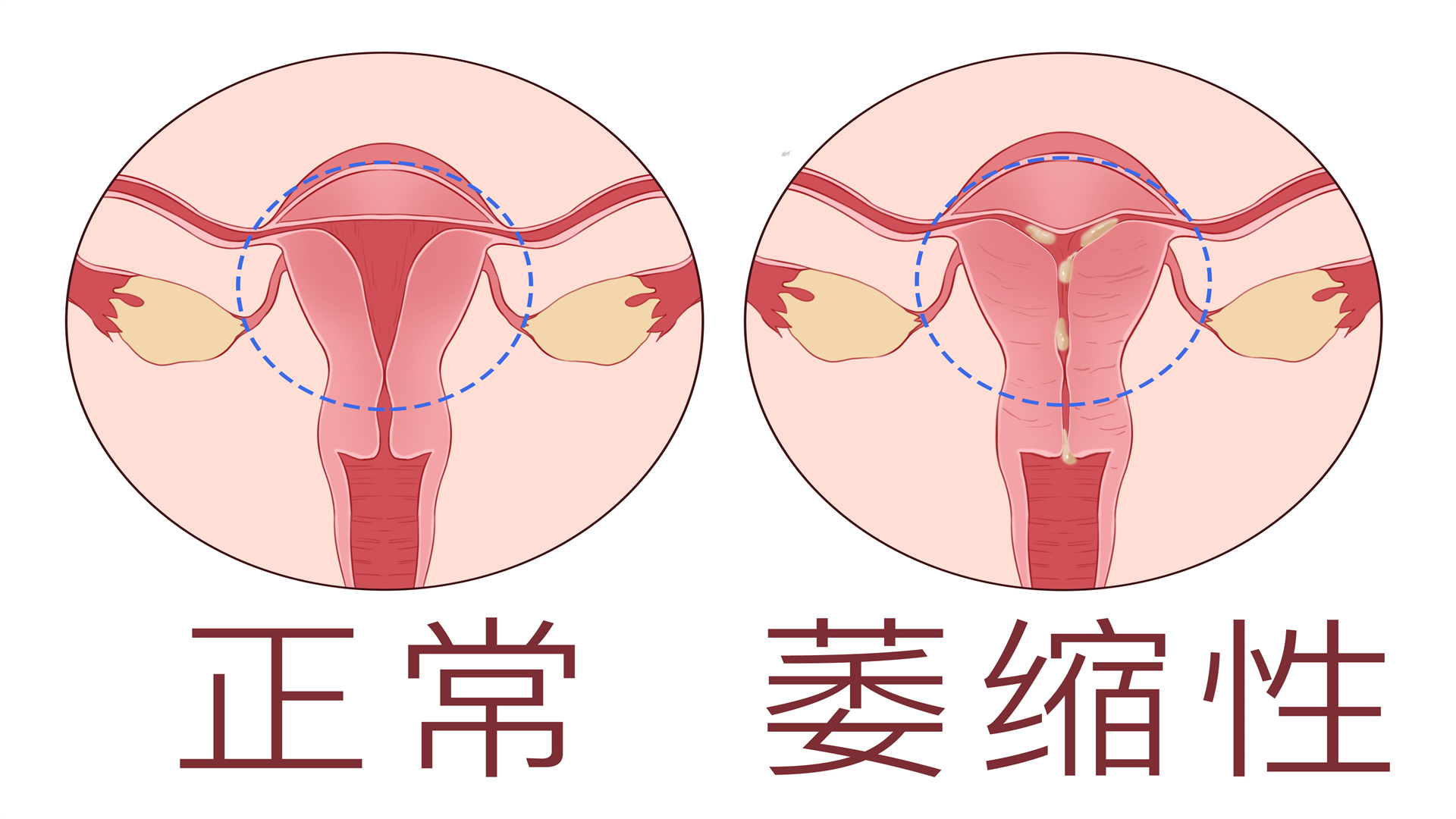 萎缩性阴道炎图片