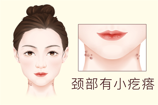 大人长痱子是湿气重吗