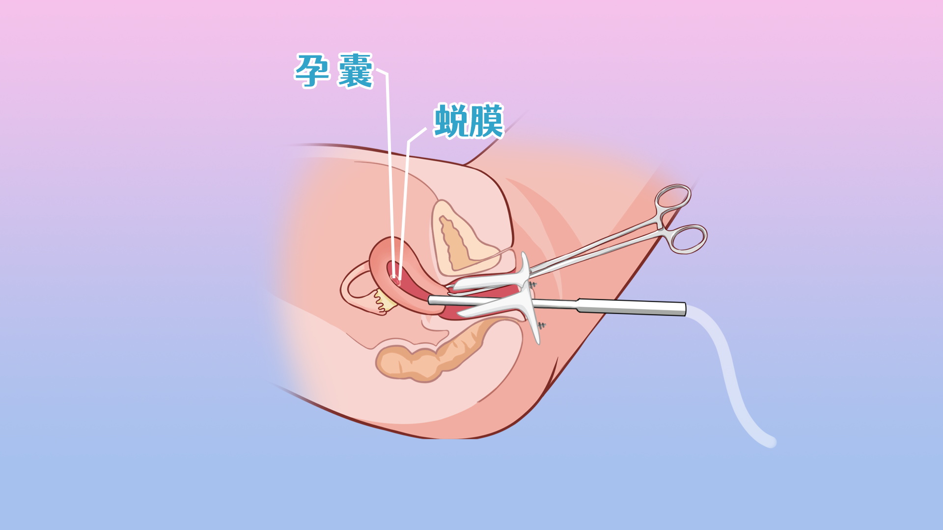 打完胎要去復(fù)查嗎