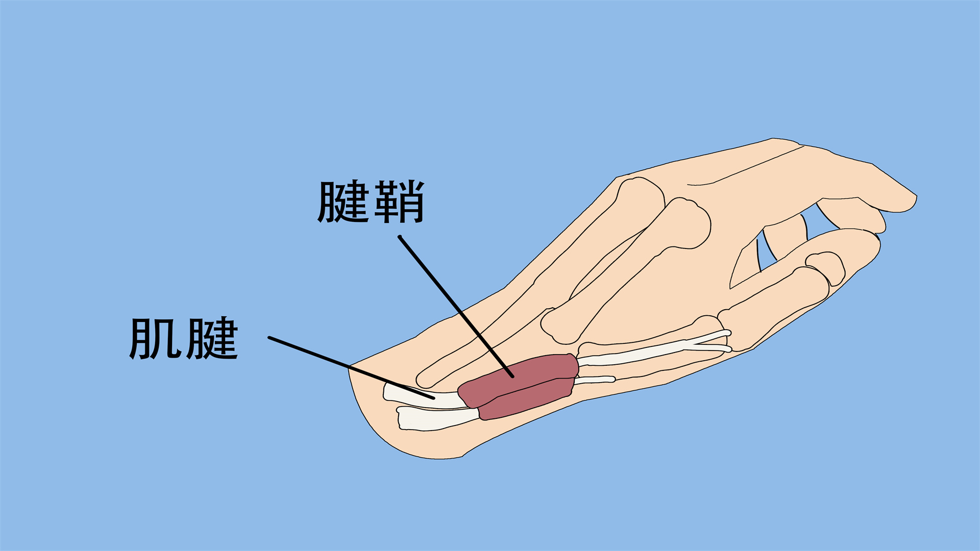 手指伸肌腱断裂怎么回事怎么办}