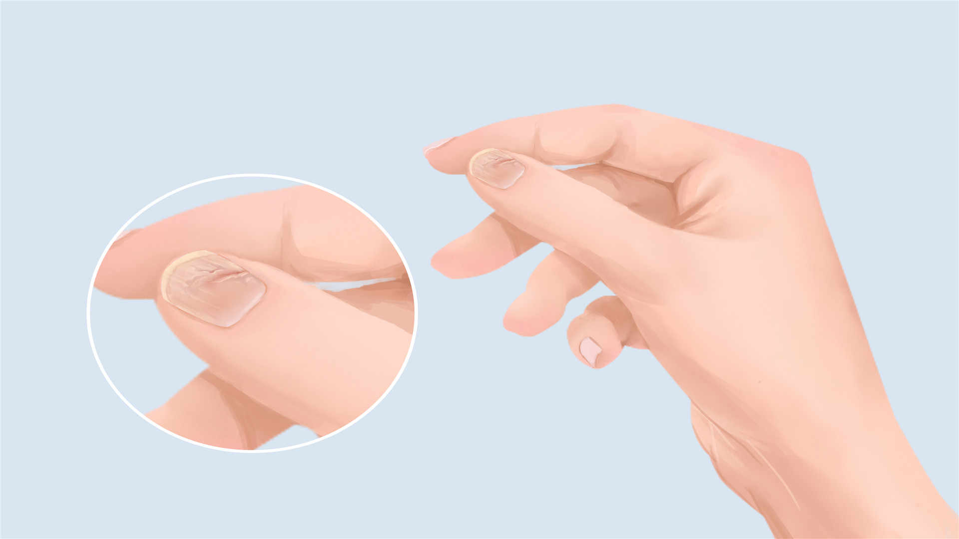 指甲盖凹凸不平是什么原因