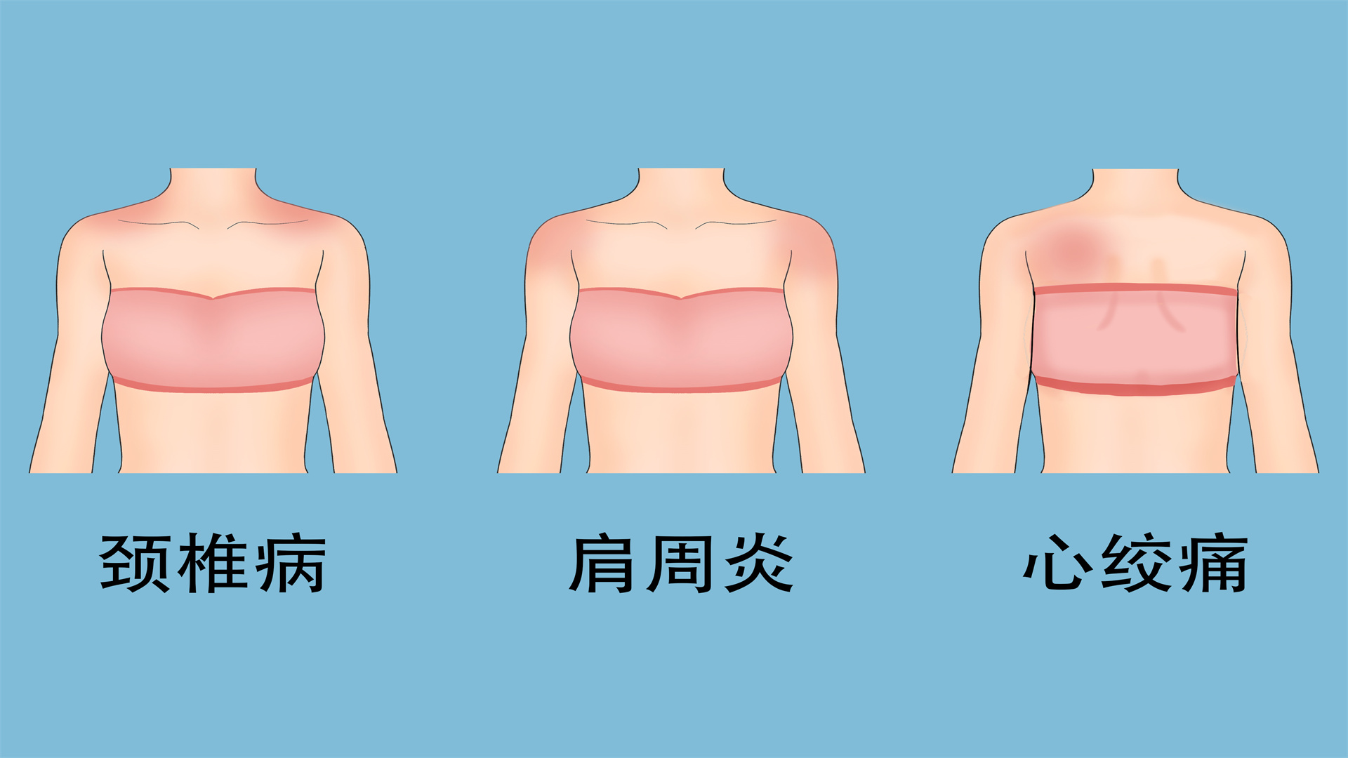 頸椎病嚴(yán)重嗎