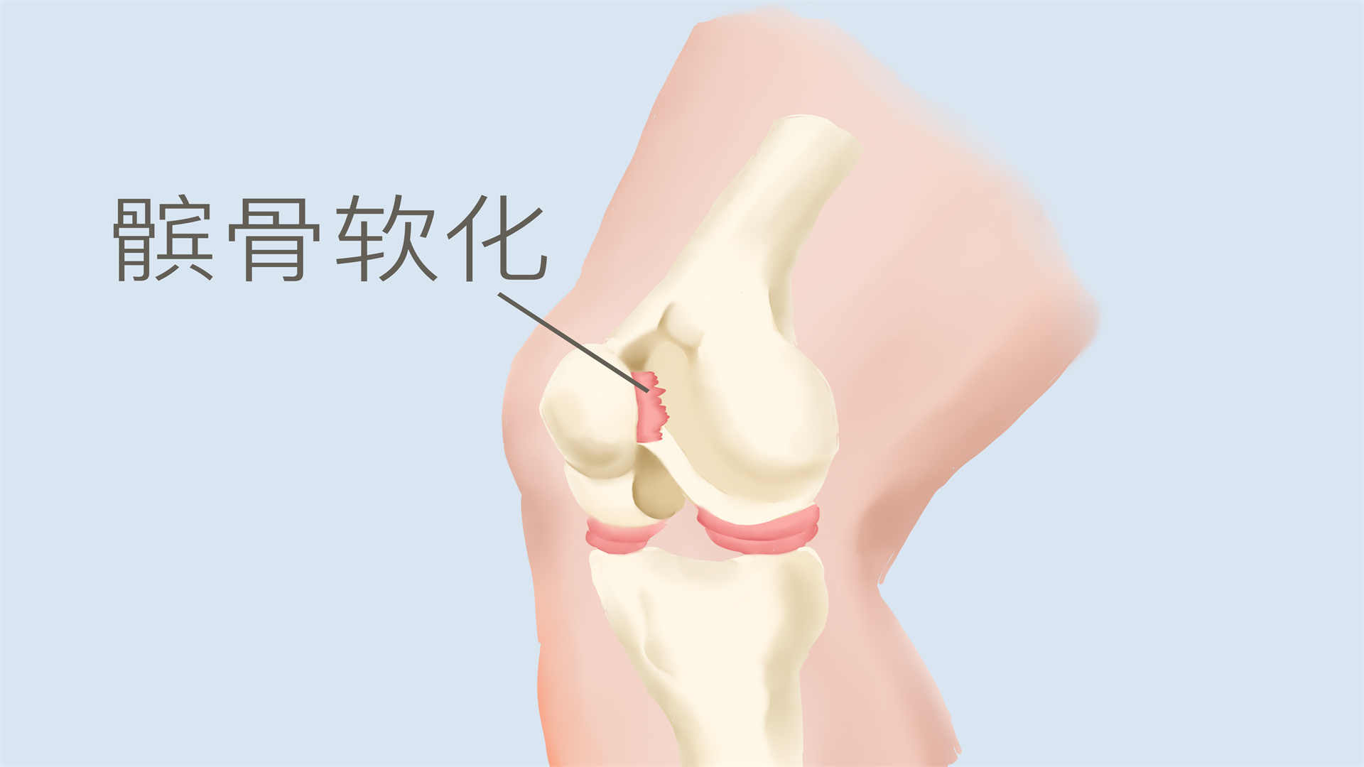 髌骨的位置是哪里}