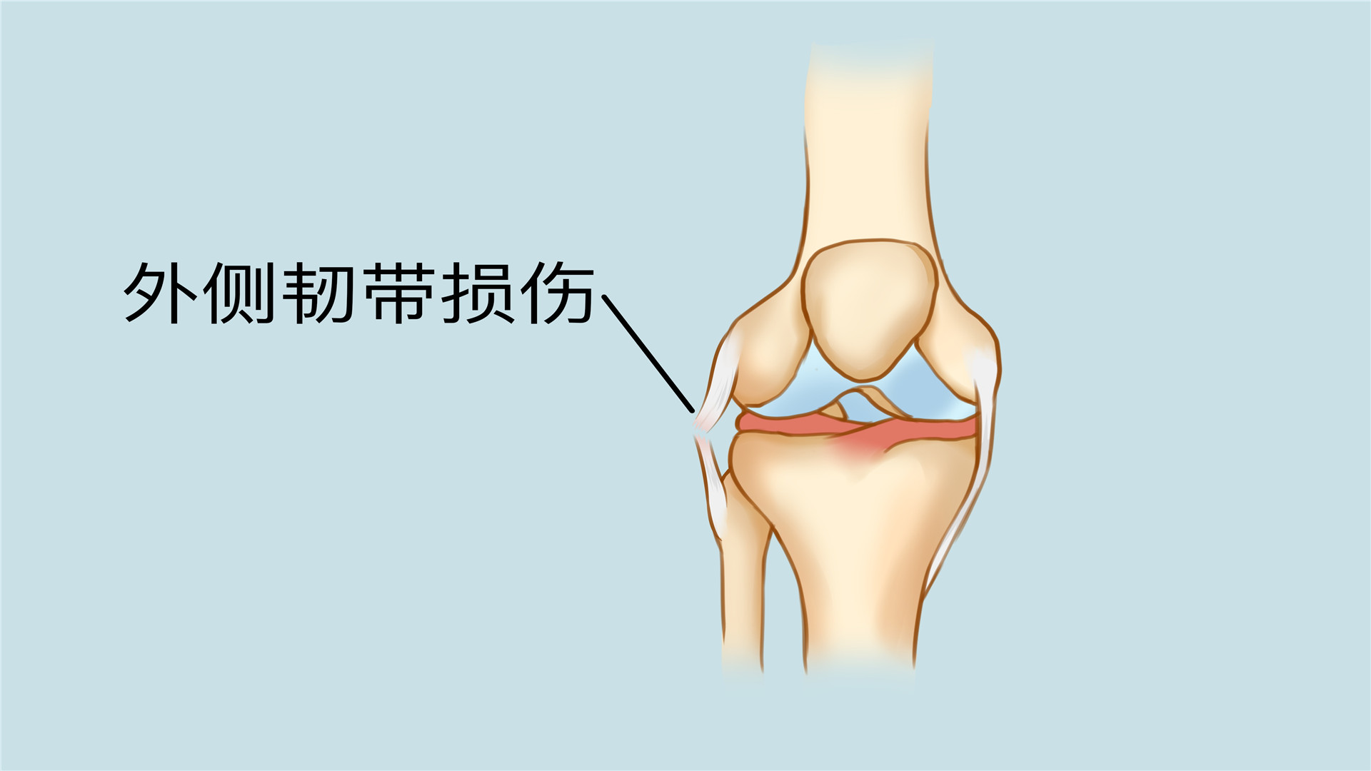 韌帶損傷能一瘸一拐走嗎