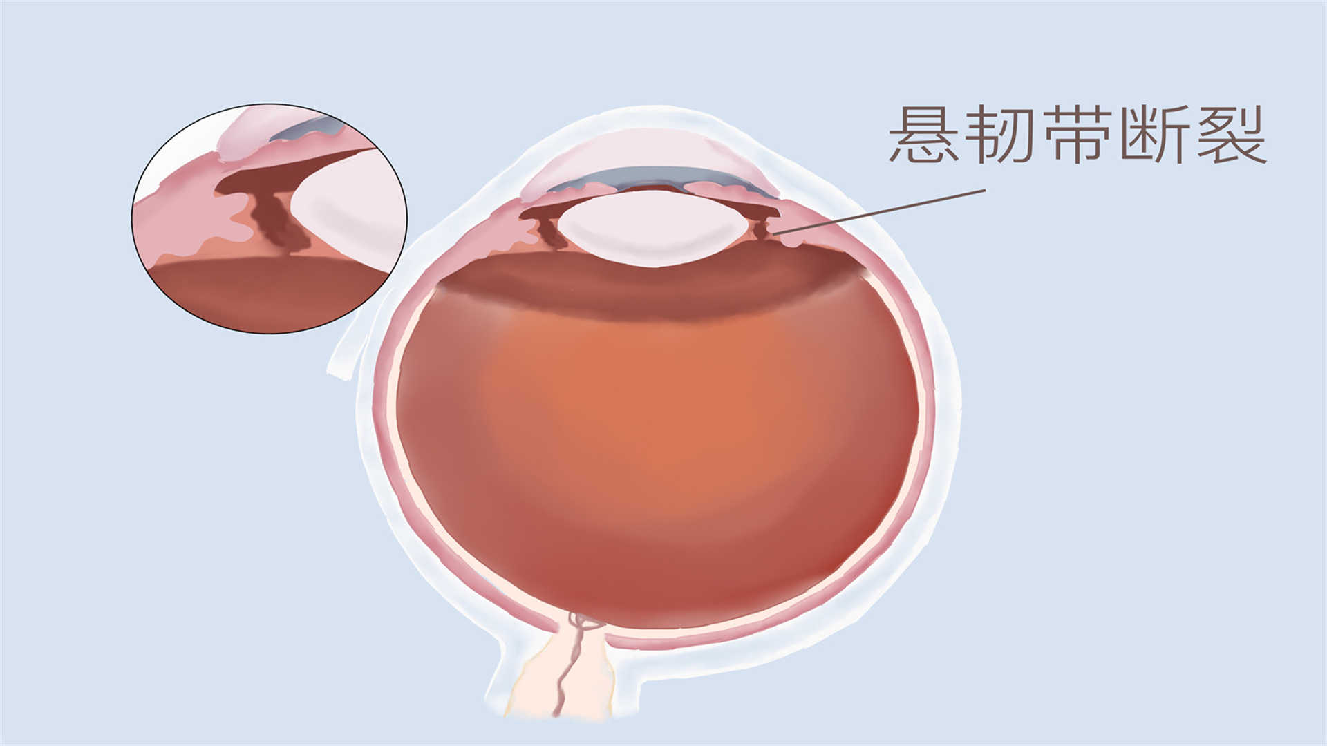 老年人白內(nèi)障的治療方法有哪些