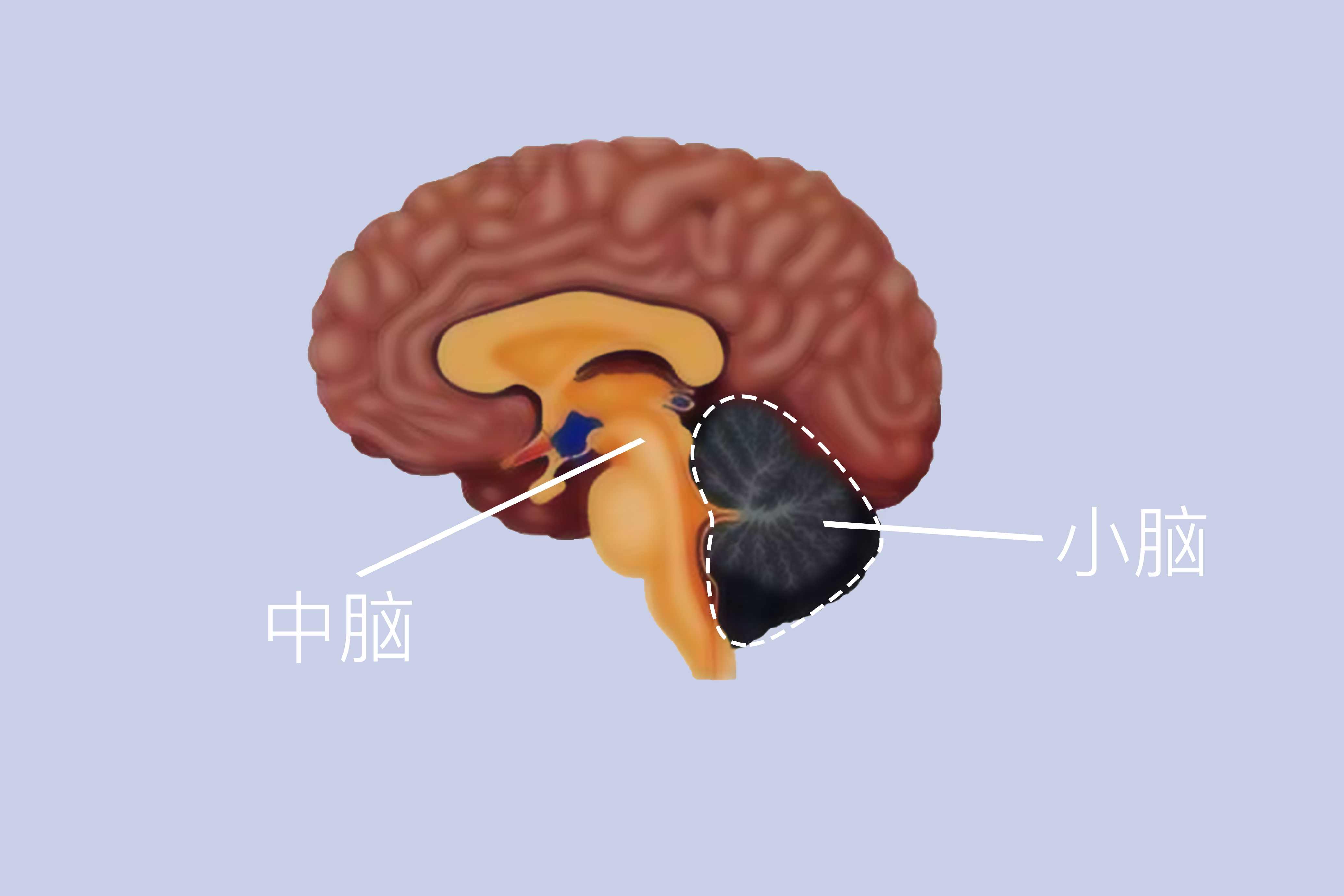 小腦萎縮就是老年癡呆癥嗎}