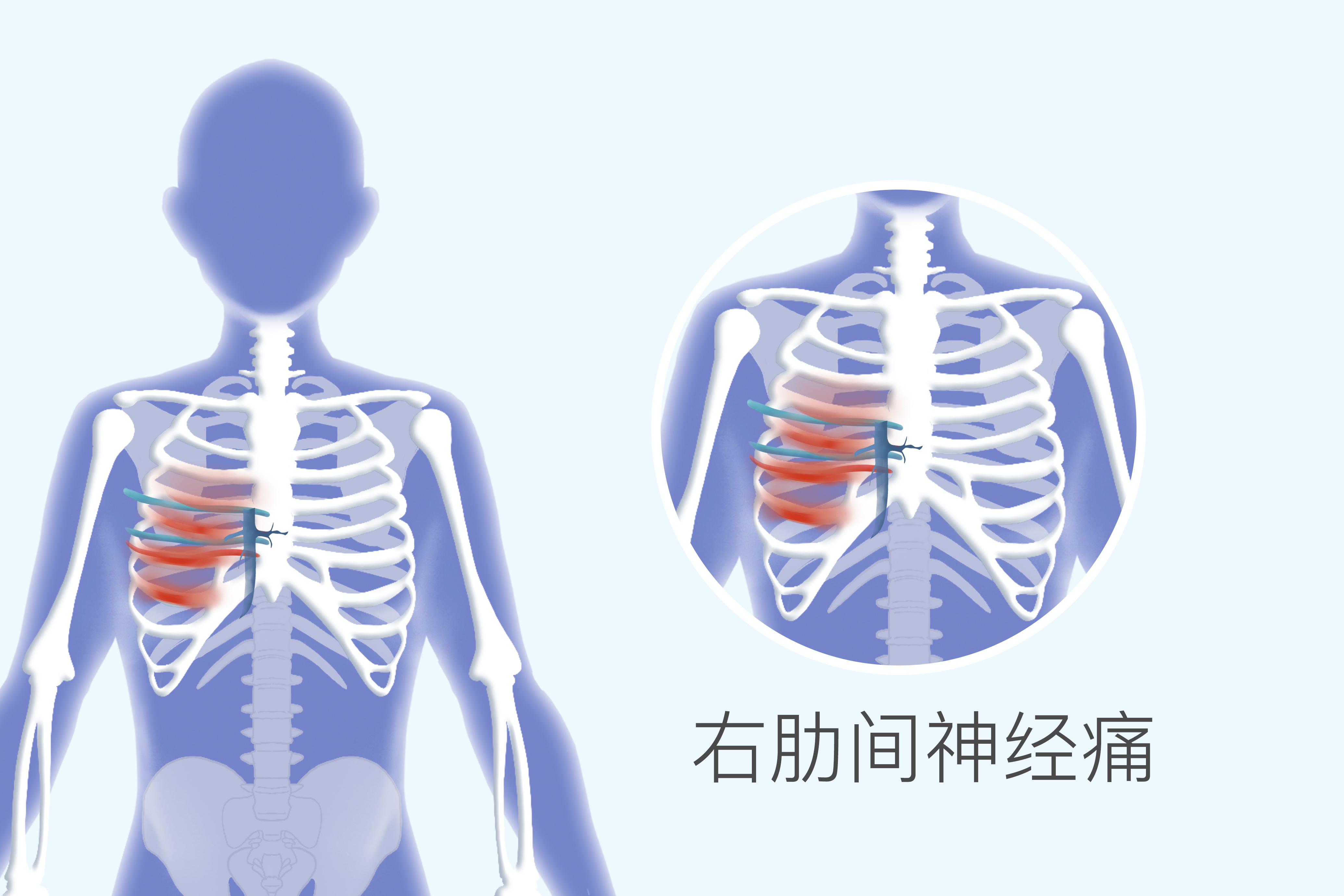 肋间神经痛是哪个部位