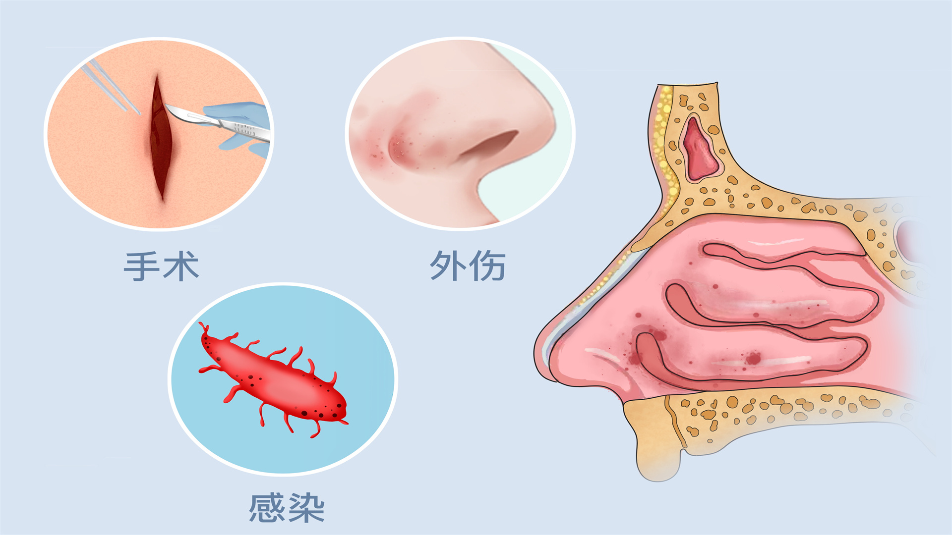 鼻甲肥大用盐水洗好吗