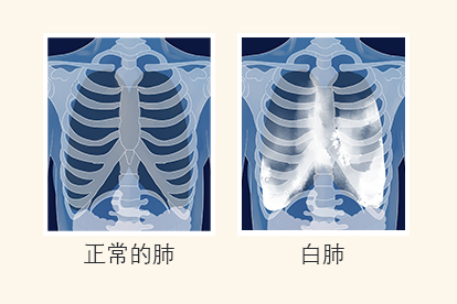 肺结核能治好吗