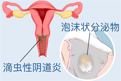 滴虫性阴道炎