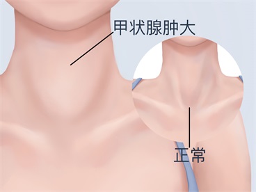 导致甲状腺肿大的原因有哪些}