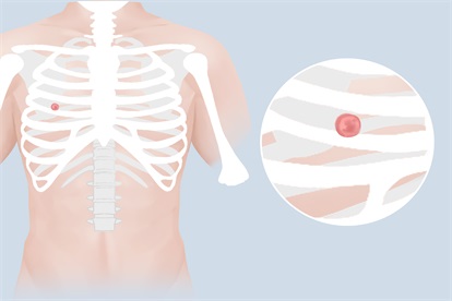 胸骨間歇性疼痛怎么回事，怎么辦