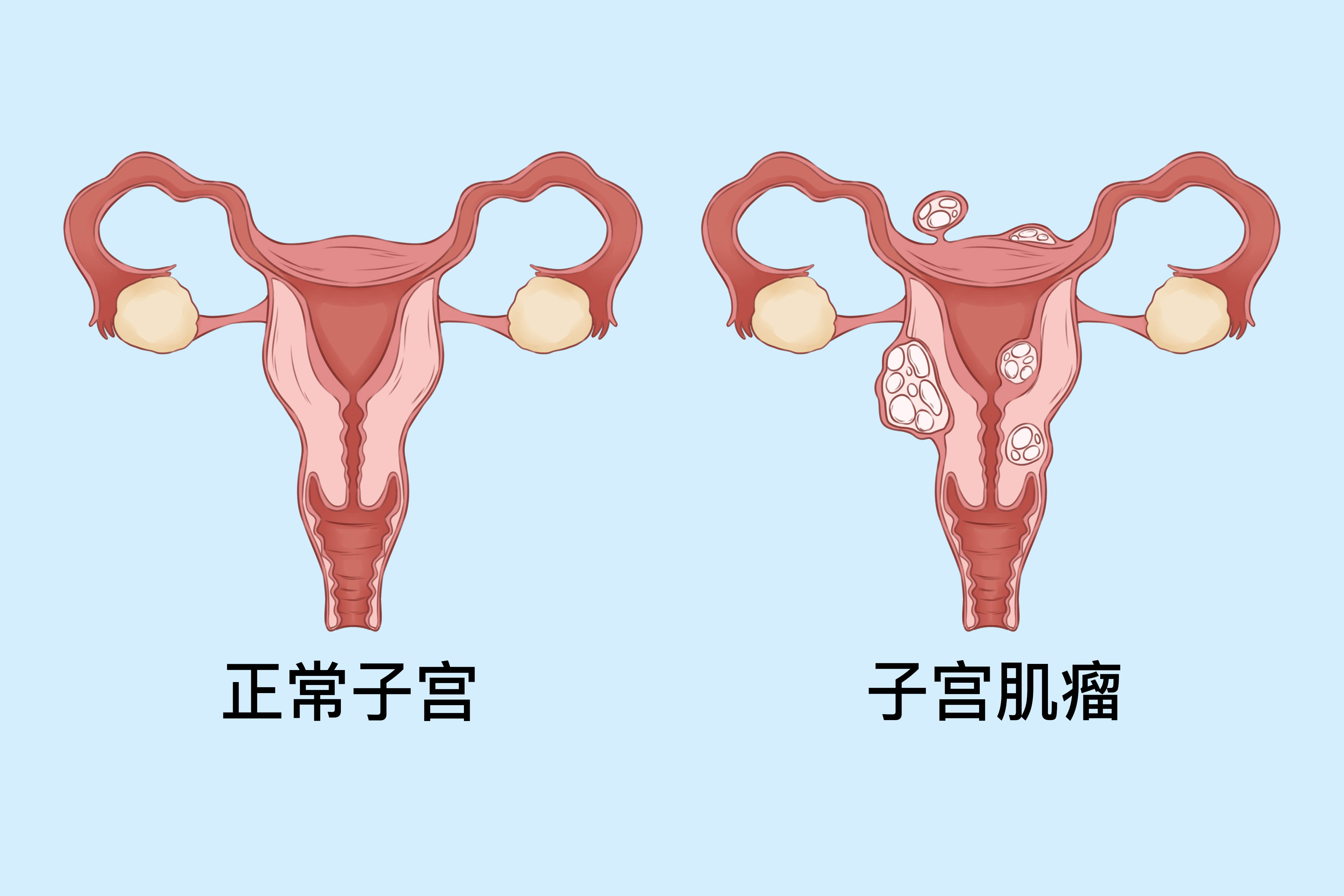 子宫肌瘤14厘米严重吗}