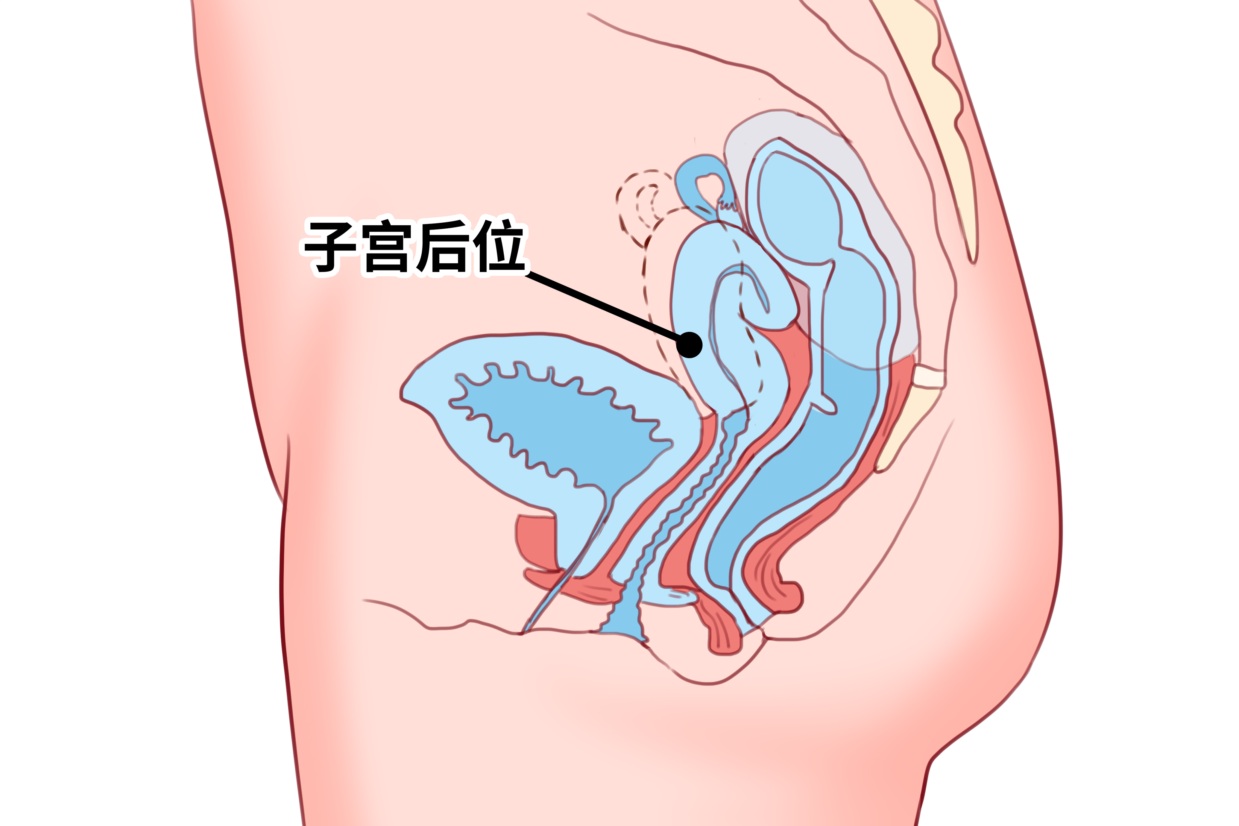 子宫憩室不治会恶变吗}