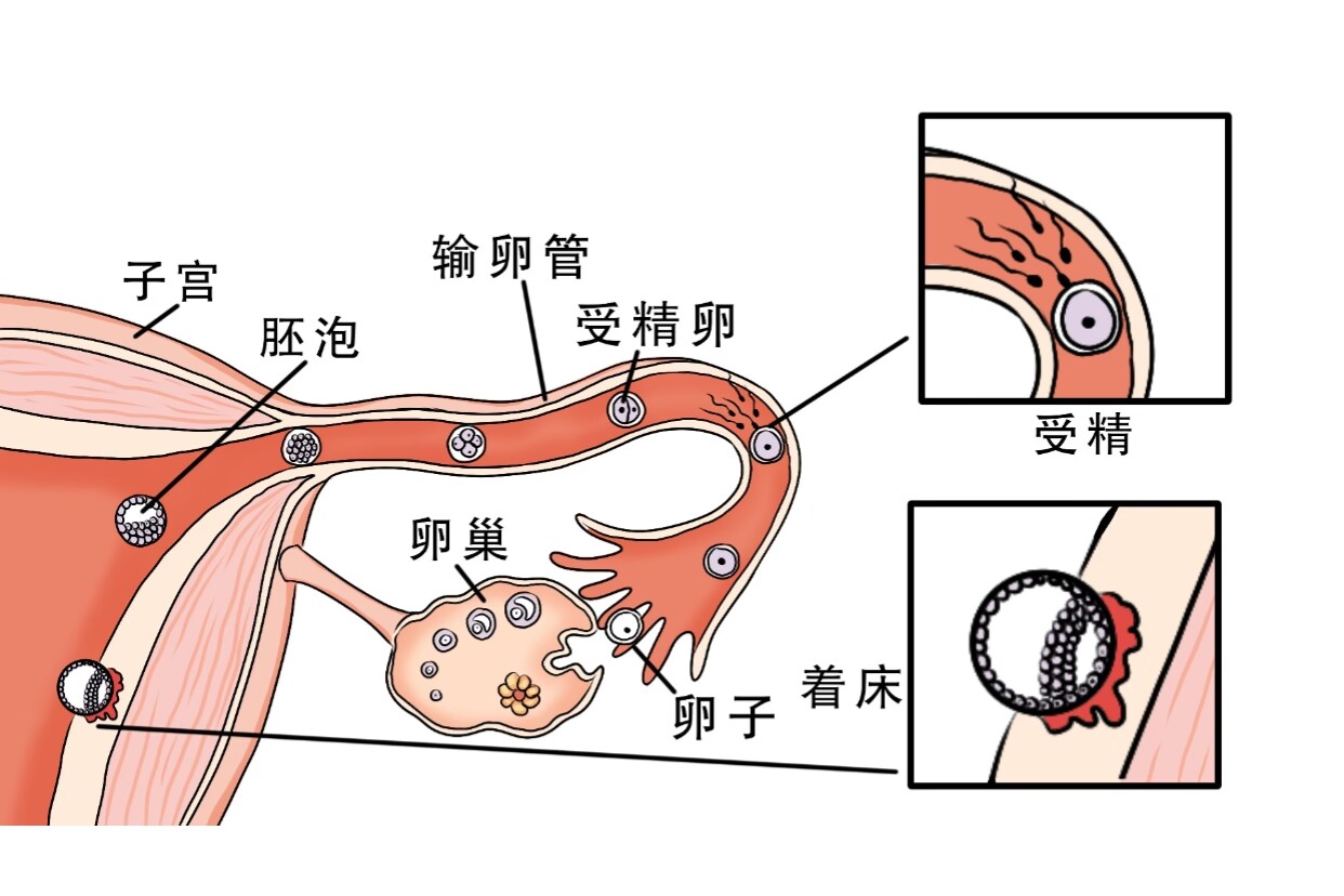 體外受精會(huì)懷孕嗎}