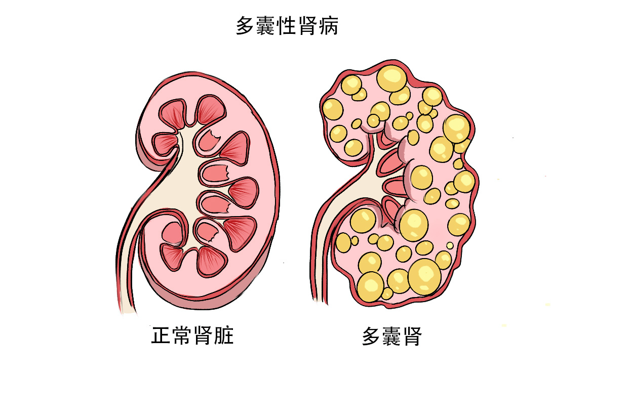 多囊卵巢月經(jīng)正常需要治療嗎