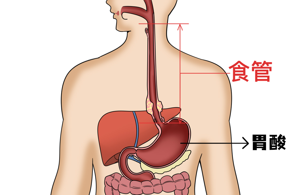 食管鳞癌为什么不建议化疗}