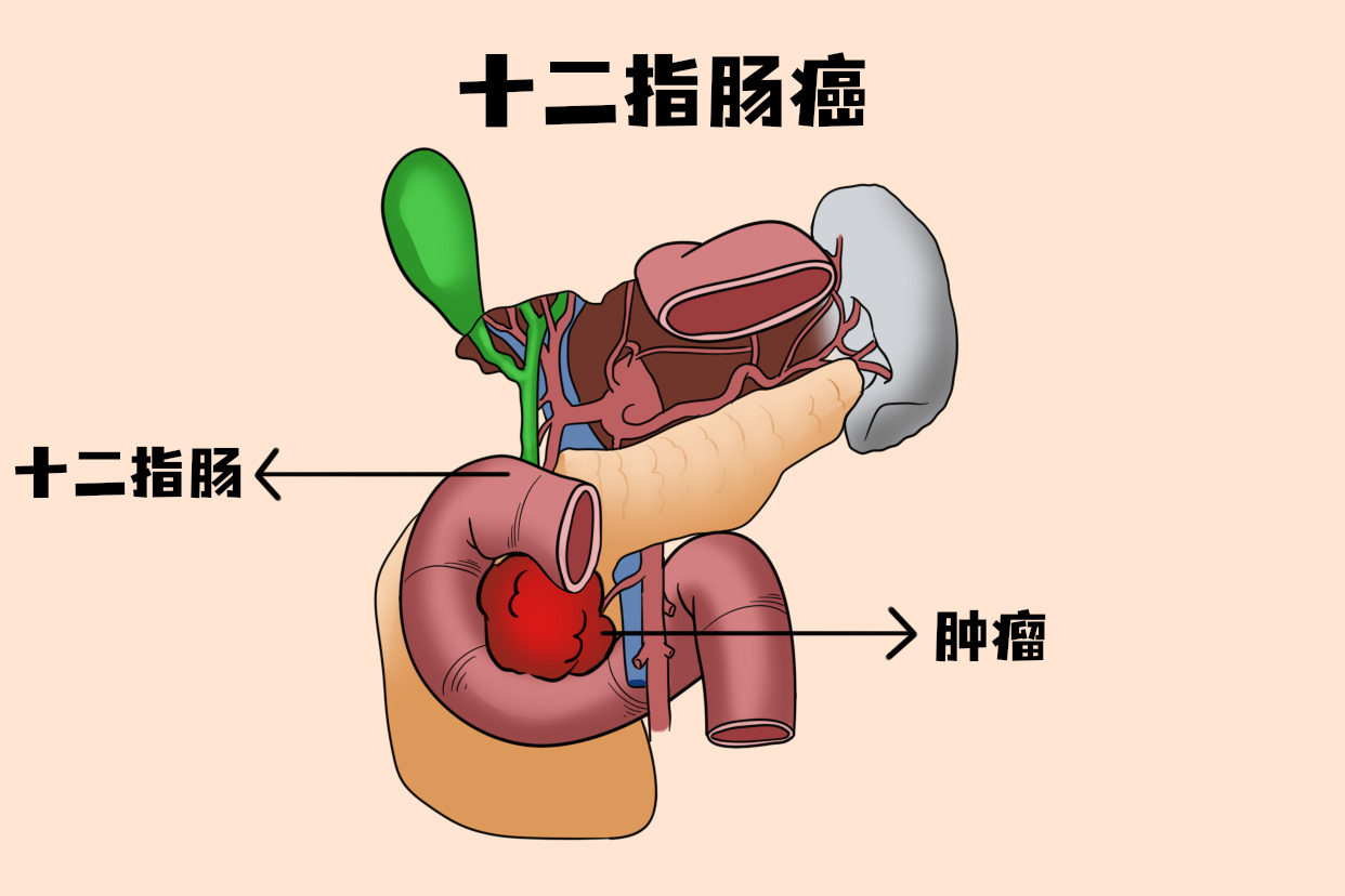 早期肠癌能活几十年吗}