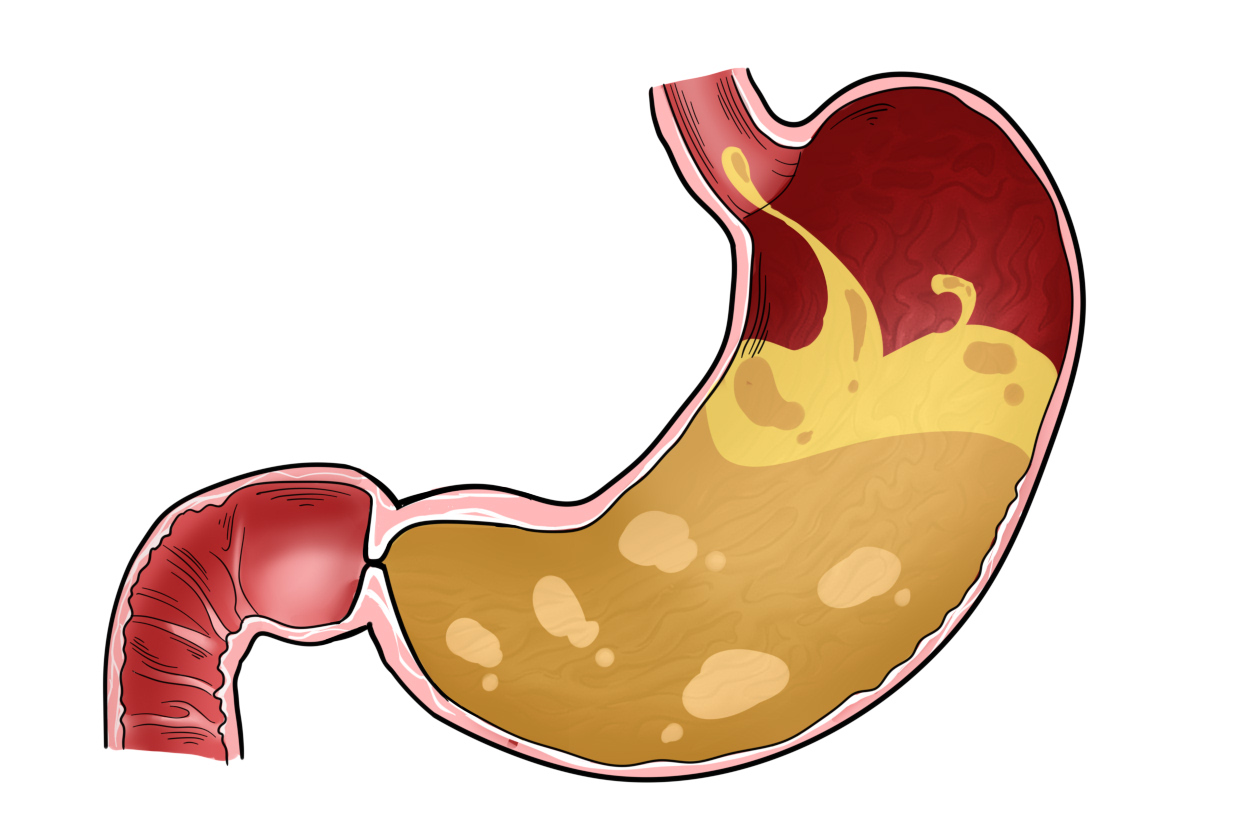 吃點東西就反酸怎么回事