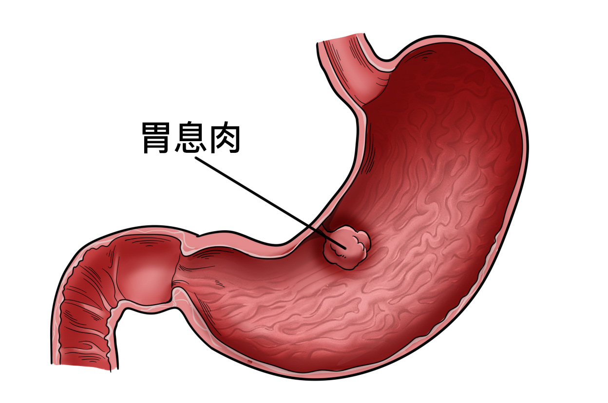 胃息肉0.3cm要切除嗎}