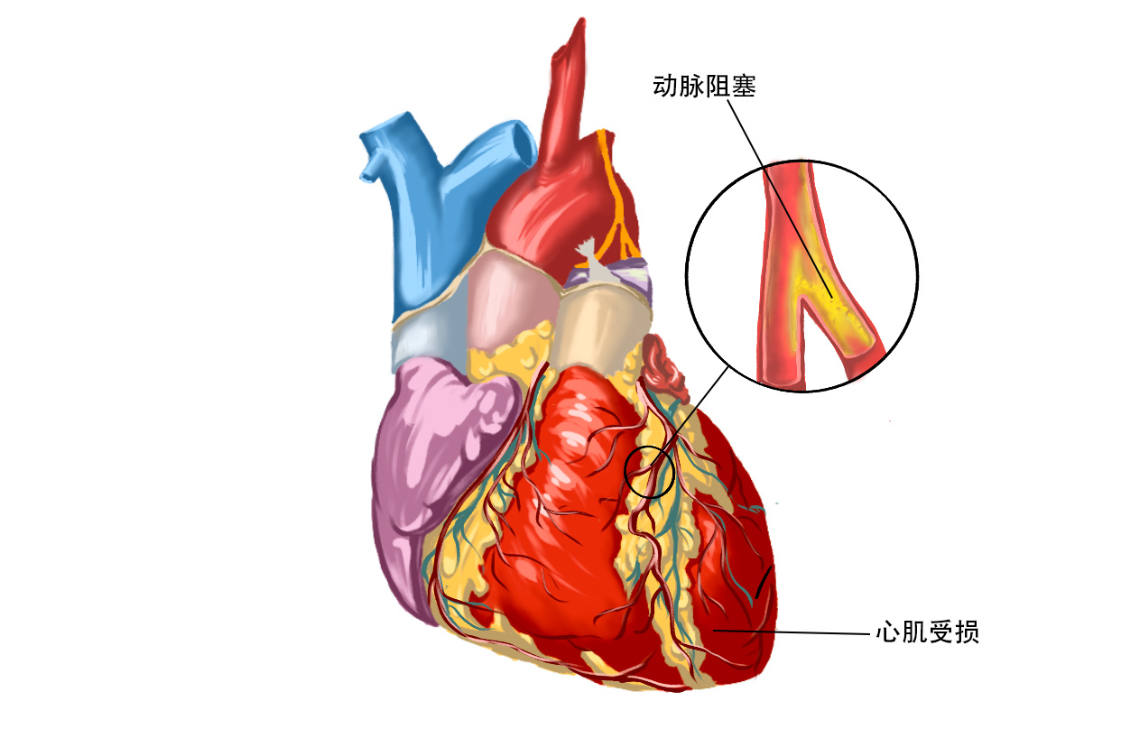 冠狀動脈粥樣硬化性心臟病如何治療}