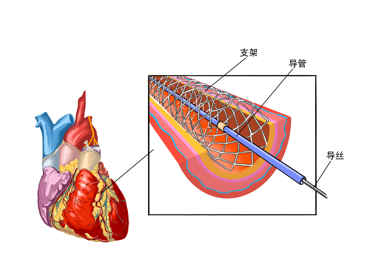 冠狀動(dòng)脈夾層破裂的早期癥狀有哪些}