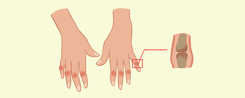 风湿类指关节痛怎么回事}
