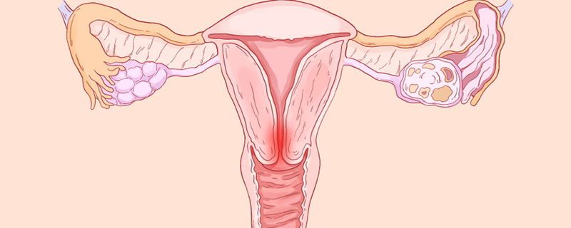 宫颈糜烂物理治疗会影响生育吗