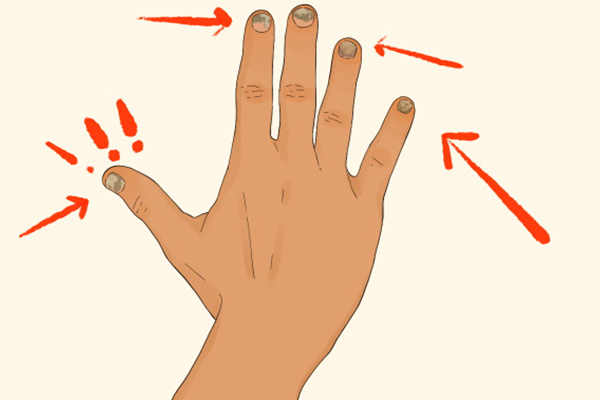 灰指甲的初期症状疼吗？