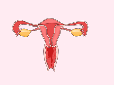 怀孕阴道出血是怎么回事？原因是什么看完就懂了
