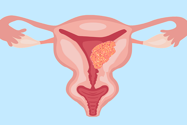 治疗子宫内膜异位的药有哪些  