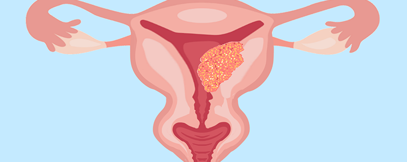子宫肌瘤症状有哪些表现
