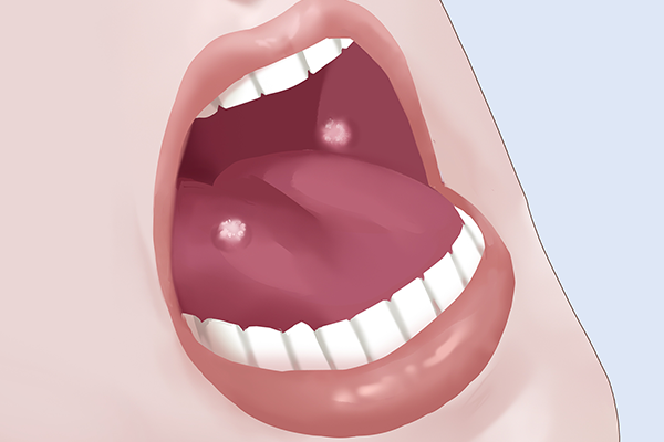 舌下腺囊肿吃什么药治疗