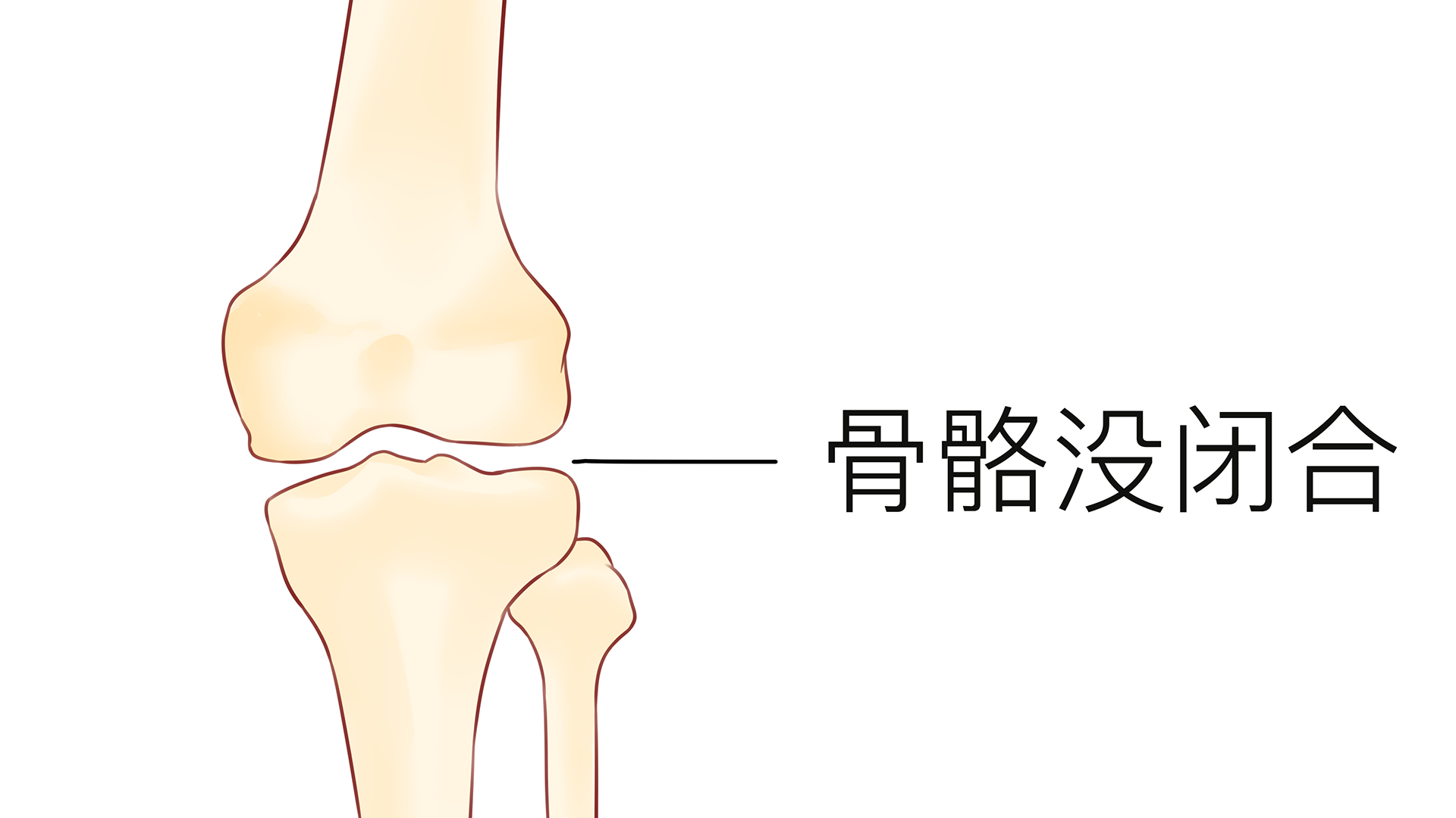 25岁骨骼闭合了吗