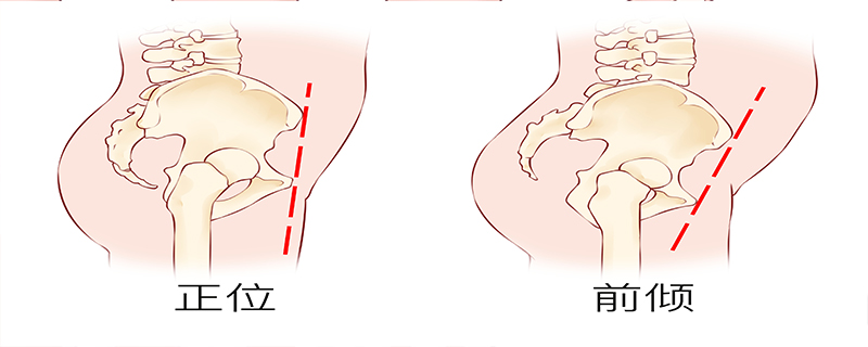 產(chǎn)后骨盆會自己恢復(fù)到產(chǎn)前狀態(tài)嗎}