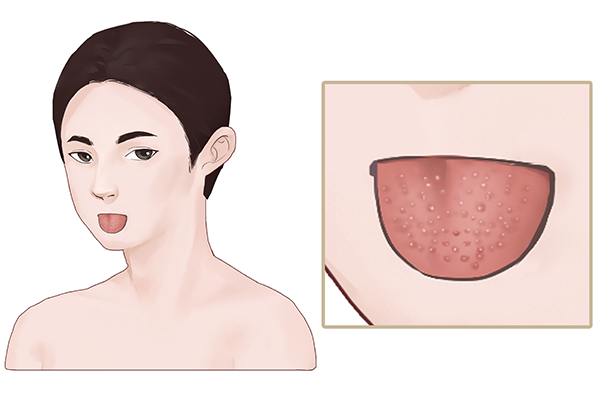 舌头有齿痕是什么病