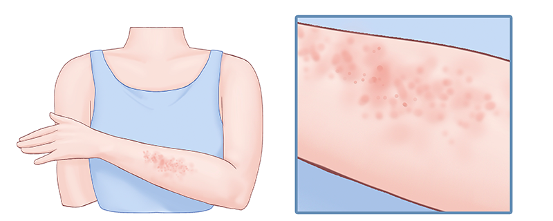 过敏性皮炎有什么症状}