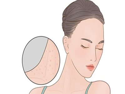 果酸祛痘做几次才有效 果酸换肤的危害