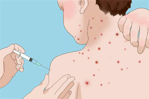 什么是荨麻疹型药疹