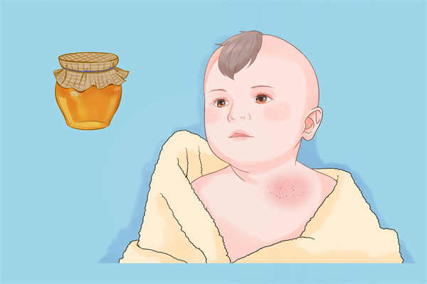 小孩身上起荨麻疹怎么治 小儿荨麻疹怎么护理