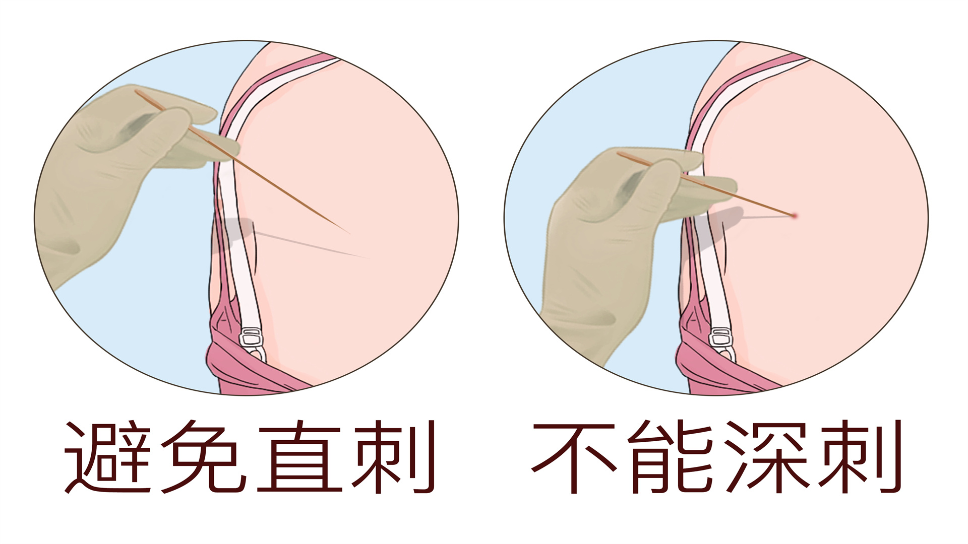 針灸能根治腰椎間盤突出嗎