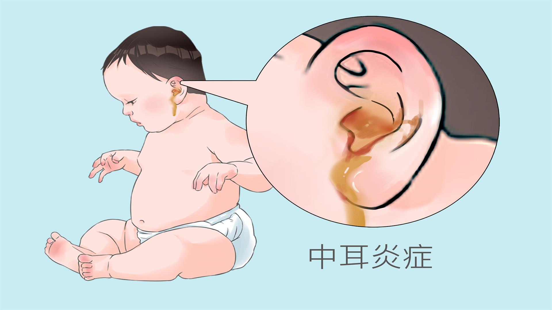 雙側中耳乳突炎是什么意思}