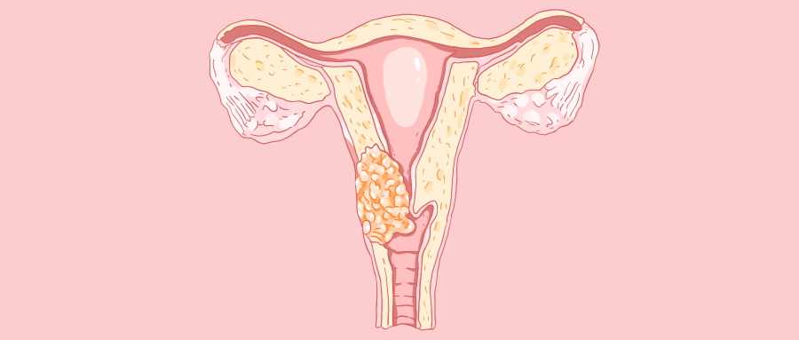 宫颈癌晚期图片 症状图片